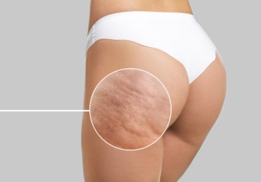Cellulite skin