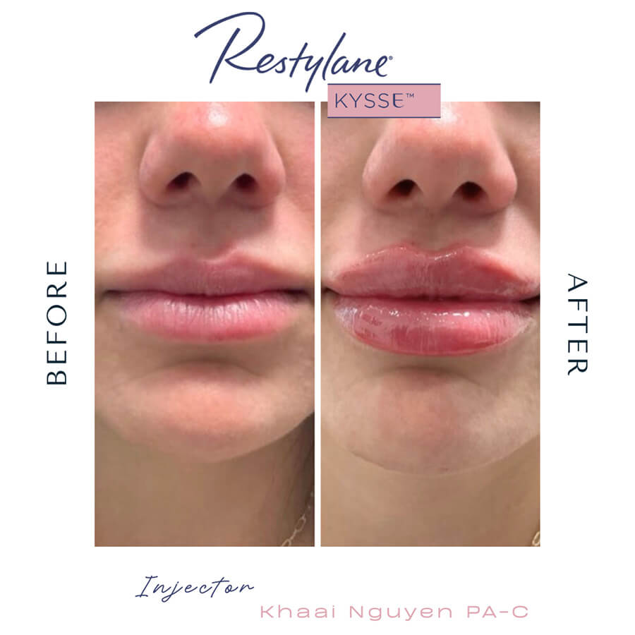 Dermal Fillers Before & After Results - Case-1