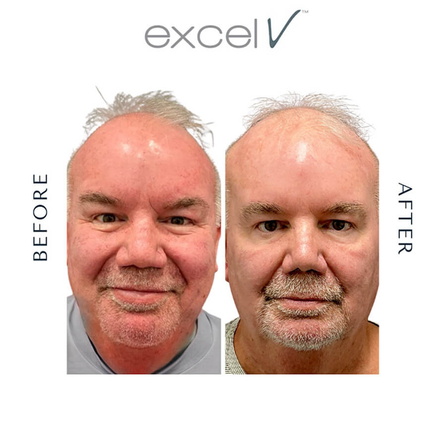 Scars & Acne Scarring Before & After Results - Case-1